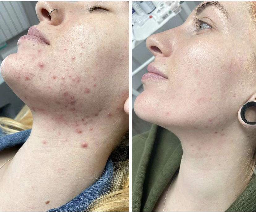 Before and after from TCA chemical peel on acne prone skin 